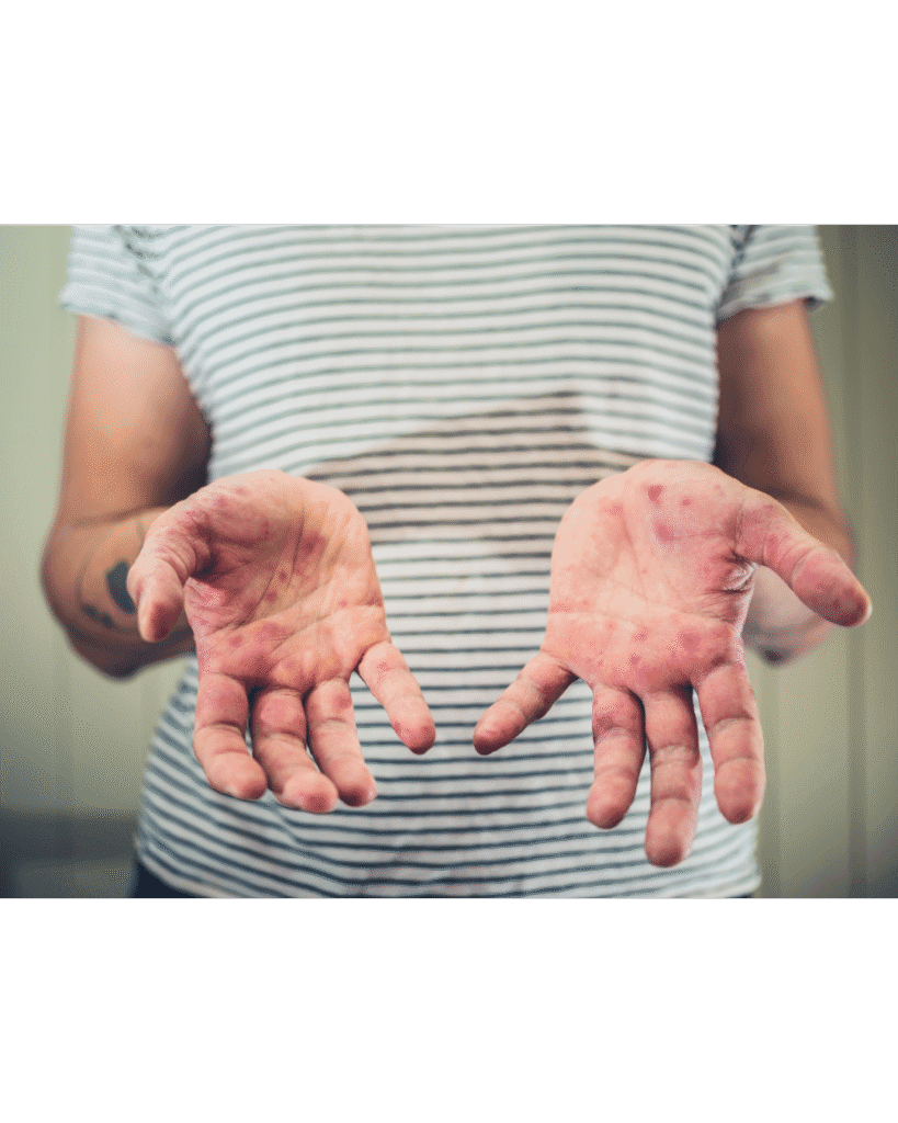 Manos de una persona con sarpullido visible, síntoma característico del sarampión durante el brote en México 2026.