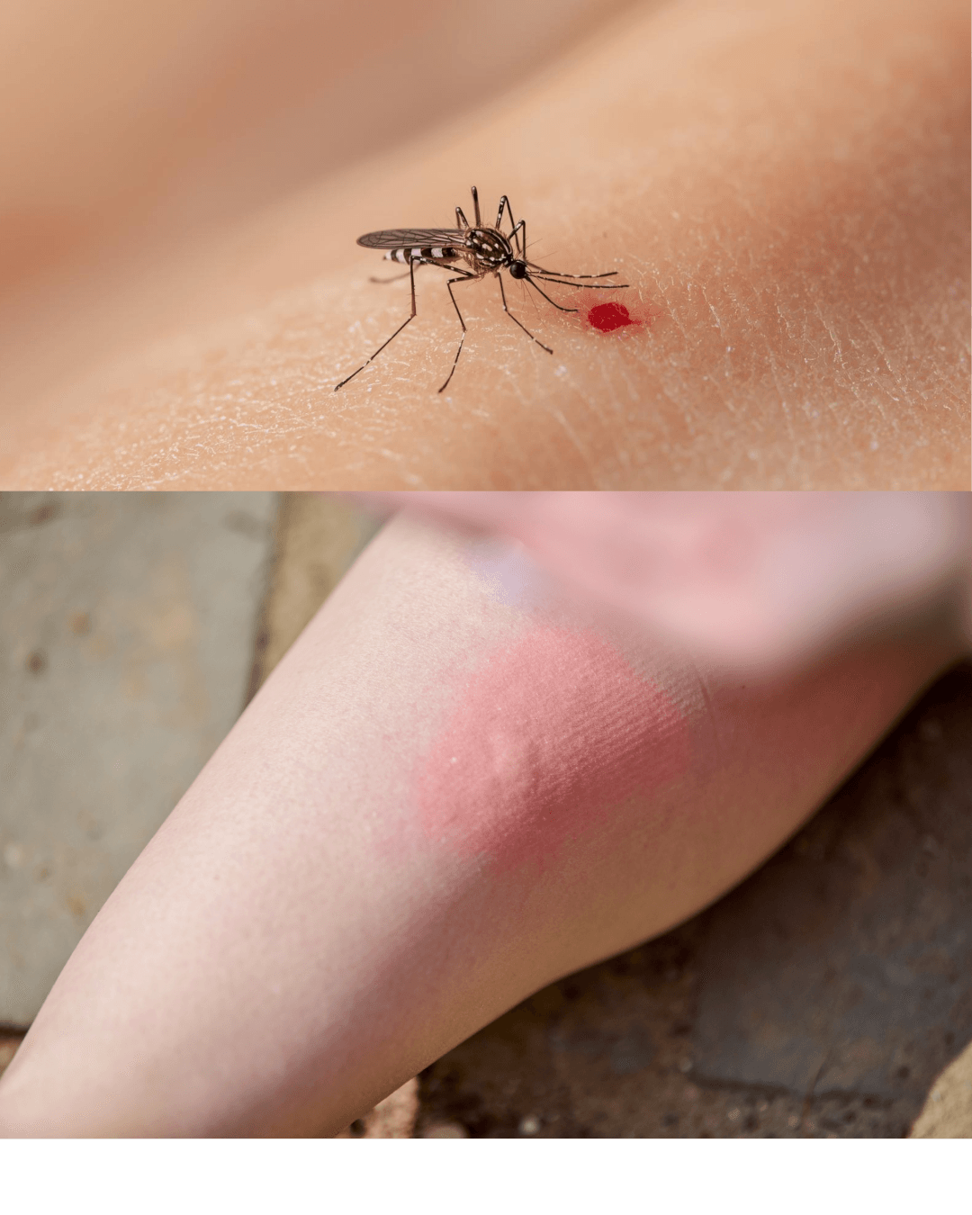 Mosquito picando la piel humana y reacción inflamatoria por picadura con enrojecimiento.