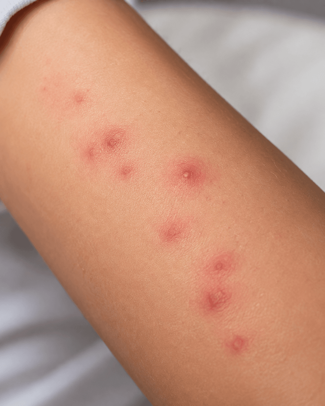Brazo con varias ronchas rojizas agrupadas, similares a las reacciones que pueden aparecer tras picaduras de chinches de cama.